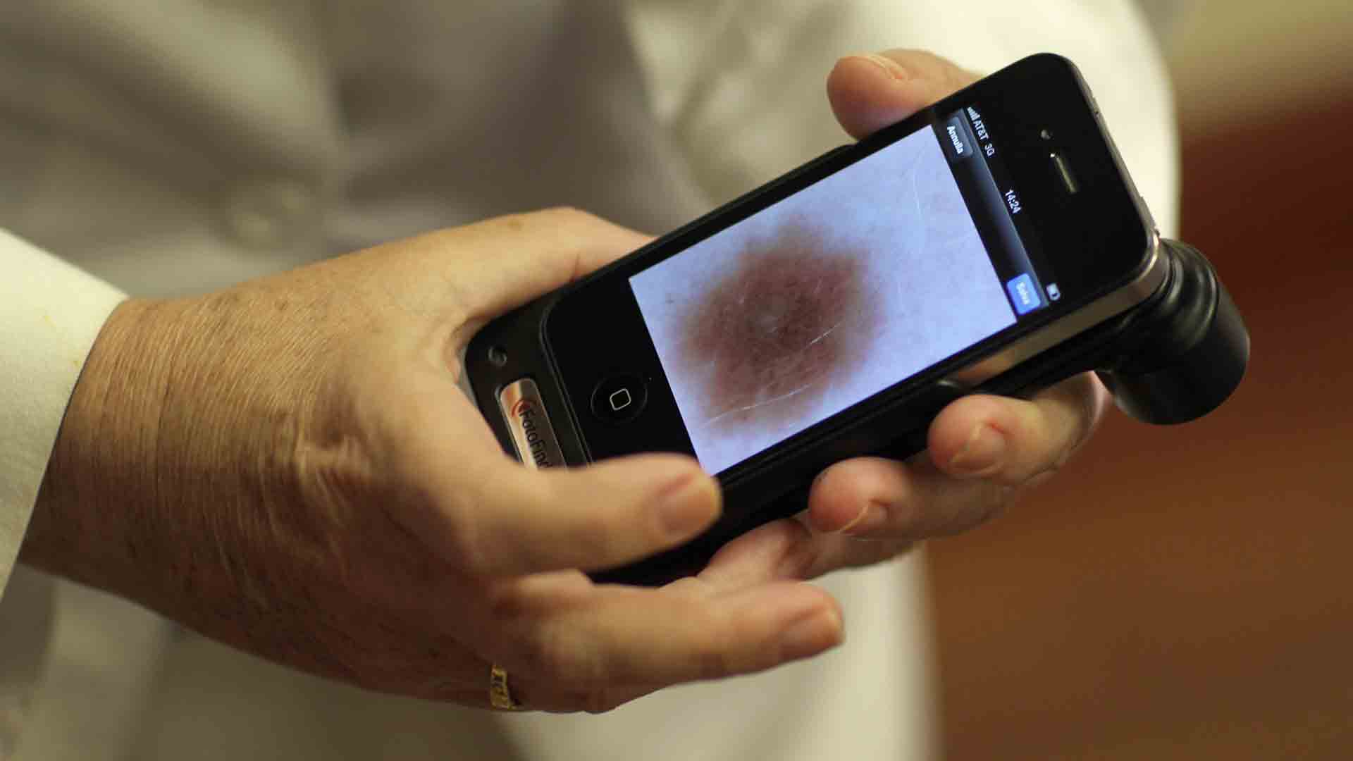 Dial a diagnosis: detecting skin cancer with a mobile phone